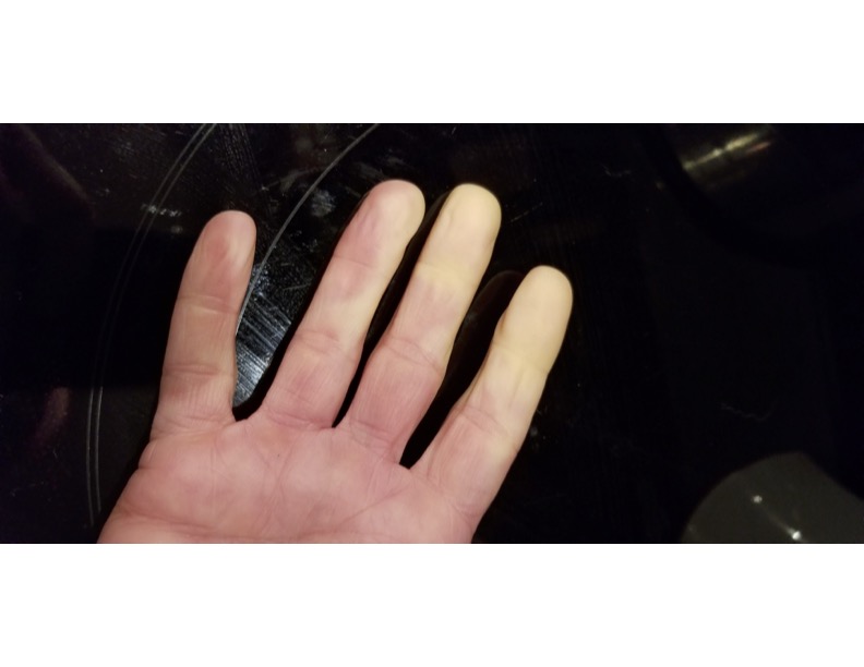 Raynaud's