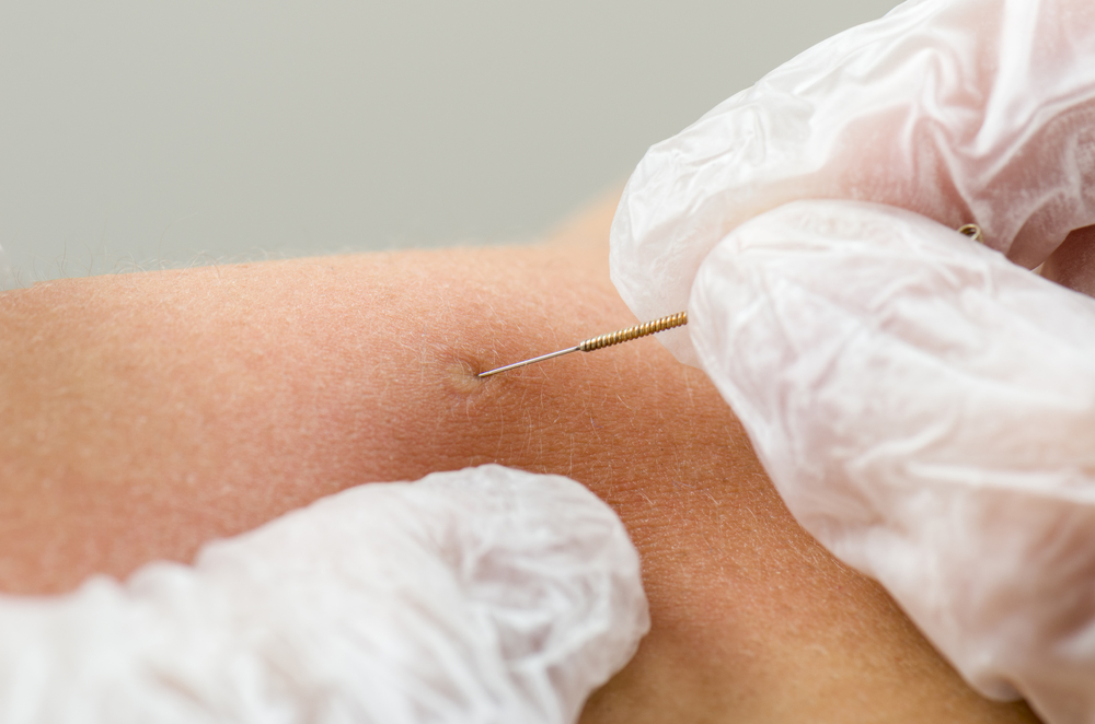 Three Benefits of Dry Needling: A Minimally Invasive Path to Pain Relief